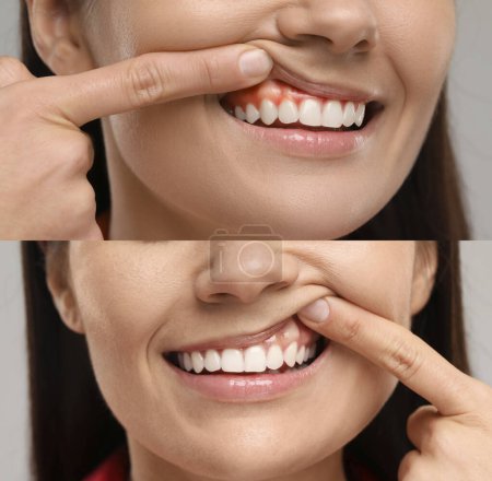 Mujer mostrando goma antes y después del tratamiento, collage de fotos