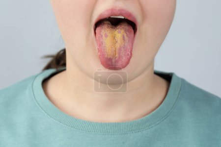 Foto de Enfermedades gastrointestinales. Mujer mostrando su lengua amarilla sobre fondo gris claro, primer plano - Imagen libre de derechos