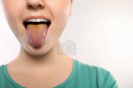 Photo for Gastrointestinal diseases. Woman showing her yellow tongue on white background, closeup - Royalty Free Image