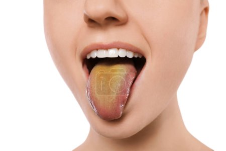 Enfermedades gastrointestinales. Mujer mostrando su lengua amarilla sobre fondo blanco, primer plano