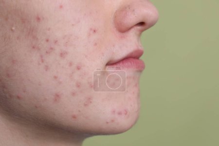 Young man with acne problem on olive background, closeup