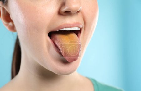 Enfermedades gastrointestinales. Mujer mostrando su lengua amarilla sobre fondo azul claro, primer plano