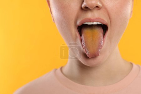 Foto de Enfermedades gastrointestinales. Mujer mostrando su lengua amarilla sobre fondo de color, primer plano - Imagen libre de derechos
