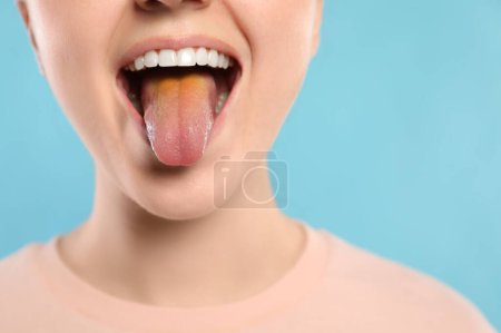 Enfermedades gastrointestinales. Mujer mostrando su lengua amarilla sobre fondo azul claro, primer plano. Espacio para texto