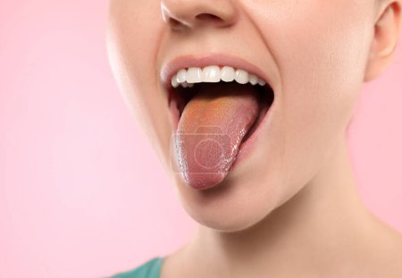 Enfermedades gastrointestinales. Mujer mostrando su lengua amarilla sobre fondo rosa, primer plano
