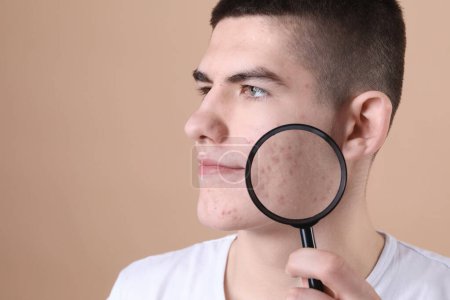Young man with acne problem holding magnifying glass on beige background. Space for text