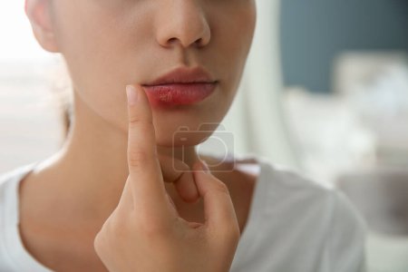 Woman with herpes touching lips against blurred background, closeup