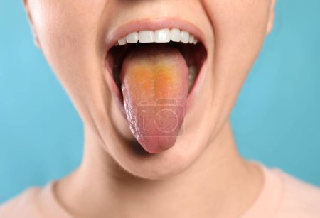 Photo for Gastrointestinal diseases. Woman showing her yellow tongue on light blue background, closeup - Royalty Free Image
