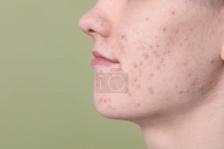 Young man with acne problem on olive background, closeup. Space for text