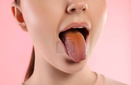 Foto de Enfermedades gastrointestinales. Mujer mostrando su lengua amarilla sobre fondo rosa, primer plano - Imagen libre de derechos