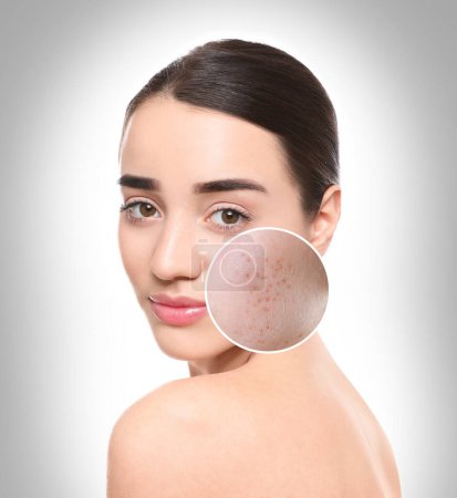 Téléchargez les photos : Femme avec de l'acné sur le visage sur fond gris dégradé. Zone zoomée montrant la peau problématique - en image libre de droit