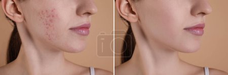Téléchargez les photos : Problème d'acné. Jeune femme avant et après traitement sur fond beige, gros plan. Collage de photos - en image libre de droit