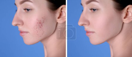 Téléchargez les photos : Problème d'acné. Jeune femme avant et après le traitement sur fond bleu, collage de photos - en image libre de droit