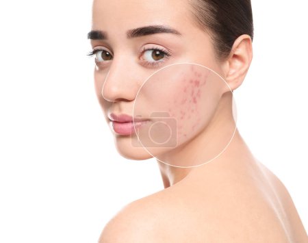 Téléchargez les photos : Femme avec acné sur le visage sur fond blanc. Zone zoomée montrant la peau problématique - en image libre de droit