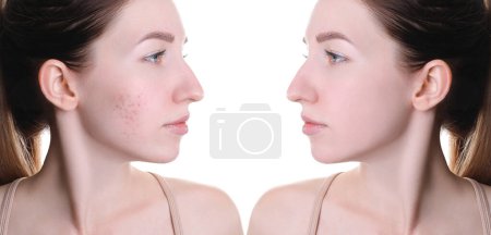 Téléchargez les photos : Problème d'acné. Jeune femme avant et après le traitement sur fond blanc, collage de photos - en image libre de droit
