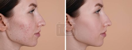 Téléchargez les photos : Problème d'acné. Jeune femme avant et après traitement sur fond beige, collage de photos - en image libre de droit