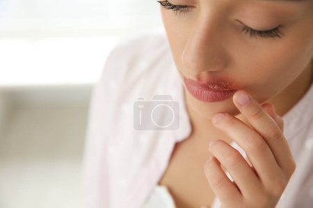 Woman with herpes touching lips against blurred background, closeup