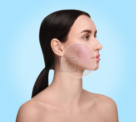 Téléchargez les photos : Femme avec de l'acné sur le visage sur fond bleu clair. Zone zoomée montrant la peau problématique - en image libre de droit