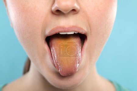 Enfermedades gastrointestinales. Mujer mostrando su lengua amarilla sobre fondo azul claro, primer plano