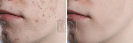 Téléchargez les photos : Problème d'acné. Jeune homme avant et après le traitement, gros plan. Collage de photos - en image libre de droit