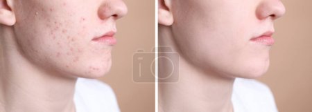 Téléchargez les photos : Problème d'acné. Jeune homme avant et après traitement sur fond beige, gros plan. Collage de photos - en image libre de droit