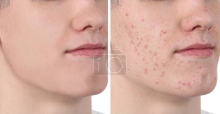 Téléchargez les photos : Problème d'acné. Jeune homme avant et après traitement sur fond blanc, gros plan. Collage de photos - en image libre de droit