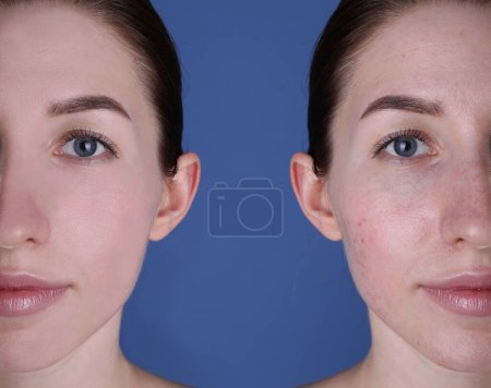 Téléchargez les photos : Problème d'acné. Jeune femme avant et après le traitement sur fond bleu, collage de photos - en image libre de droit