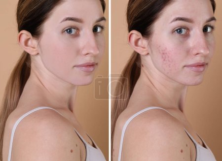 Téléchargez les photos : Problème d'acné. Jeune femme avant et après traitement sur fond beige, collage de photos - en image libre de droit