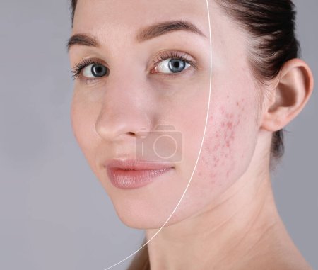 Téléchargez les photos : Problème d'acné, collage. Femme avant et après le traitement sur fond gris - en image libre de droit