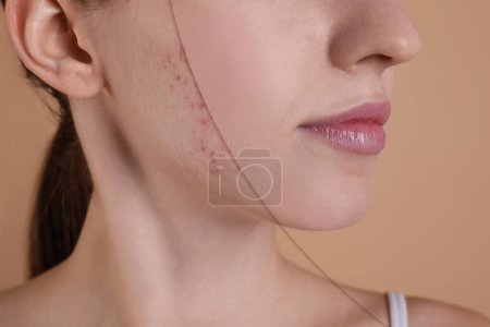 Téléchargez les photos : Problème d'acné, collage. Photo de la femme divisée en deux avant et après le traitement sur fond beige, gros plan - en image libre de droit