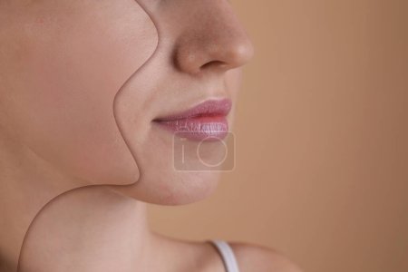 Téléchargez les photos : Problème d'acné, collage. Femme avant et après traitement sur fond beige, gros plan. Espace pour le texte - en image libre de droit