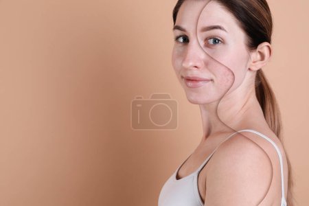 Téléchargez les photos : Problème d'acné, collage. Femme avant et après traitement sur fond beige, espace pour le texte - en image libre de droit