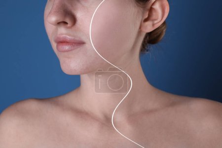 Téléchargez les photos : Problème d'acné. Photo de la femme divisée en deux avant et après le traitement sur fond bleu, gros plan - en image libre de droit