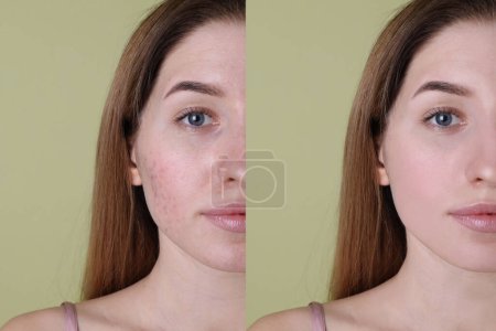 Téléchargez les photos : Problème d'acné. Jeune femme avant et après le traitement sur fond vert, collage de photos - en image libre de droit