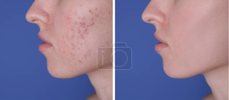 Téléchargez les photos : Problème d'acné. Jeune femme avant et après le traitement sur fond bleu, gros plan. Collage de photos - en image libre de droit
