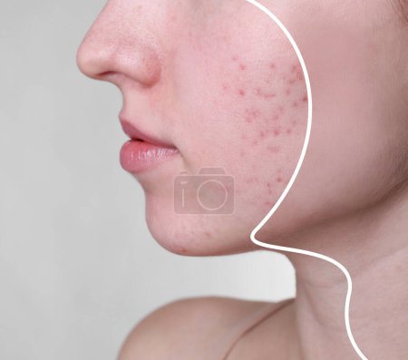 Téléchargez les photos : Problème d'acné, collage. Femme avant et après traitement sur fond gris, gros plan - en image libre de droit