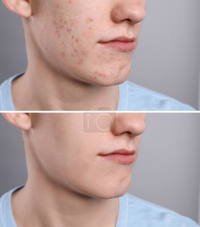Téléchargez les photos : Problème d'acné. Jeune homme avant et après traitement sur fond gris, gros plan. Collage de photos - en image libre de droit