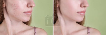 Téléchargez les photos : Problème d'acné. Jeune femme avant et après le traitement sur fond vert, gros plan. Collage de photos - en image libre de droit