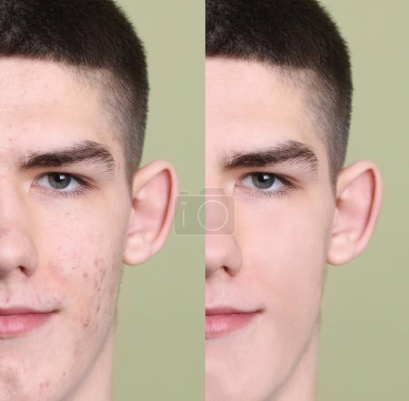 Téléchargez les photos : Problème d'acné. Jeune homme avant et après le traitement sur fond vert, collage de photos - en image libre de droit