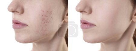 Téléchargez les photos : Problème d'acné. Jeune femme avant et après le traitement sur fond blanc, gros plan. Collage de photos - en image libre de droit