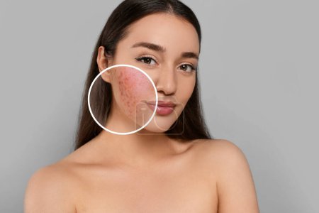 Téléchargez les photos : Femme avec de l'acné sur le visage sur fond gris. Zone zoomée montrant la peau problématique - en image libre de droit
