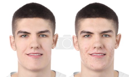 Téléchargez les photos : Problème d'acné. Jeune homme avant et après le traitement sur fond blanc, collage de photos - en image libre de droit