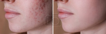Téléchargez les photos : Problème d'acné. Jeune femme avant et après traitement sur fond beige, gros plan. Collage de photos - en image libre de droit
