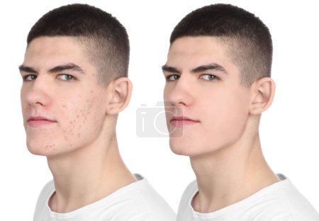 Téléchargez les photos : Problème d'acné. Jeune homme avant et après le traitement sur fond blanc, collage de photos - en image libre de droit