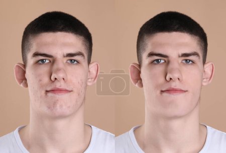 Téléchargez les photos : Problème d'acné. Jeune homme avant et après traitement sur fond beige, collage de photos - en image libre de droit