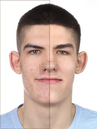 Téléchargez les photos : Problème d'acné, collage. Photo de l'homme divisé en deux avant et après le traitement sur fond blanc - en image libre de droit