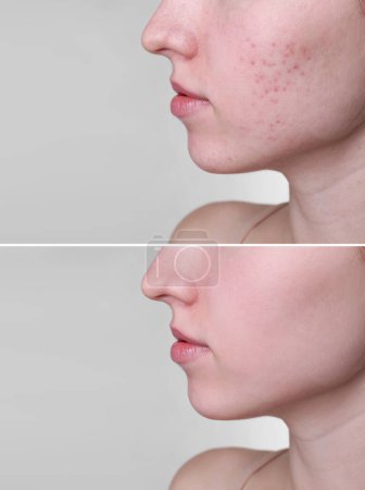 Téléchargez les photos : Problème d'acné. Jeune femme avant et après traitement sur fond gris clair, gros plan. Collage de photos - en image libre de droit