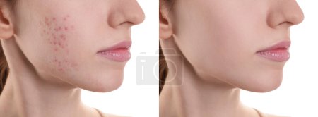 Téléchargez les photos : Problème d'acné. Jeune femme avant et après le traitement sur fond blanc, gros plan. Collage de photos - en image libre de droit