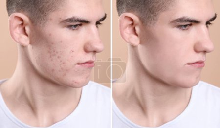 Téléchargez les photos : Problème d'acné. Jeune homme avant et après traitement sur fond beige, collage de photos - en image libre de droit