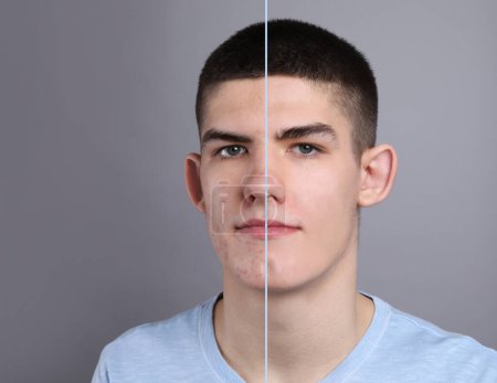 Téléchargez les photos : Problème d'acné, collage. Photo de l'homme divisé en deux avant et après le traitement sur fond gris - en image libre de droit